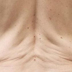 Morpheus8 Before & After Patient #1626